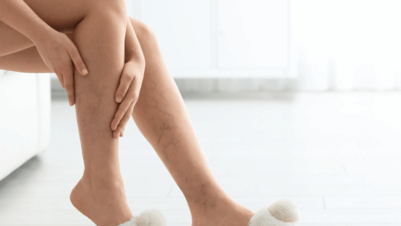 Cames d'una persona asseguda, on s'aprecien varius, una qüestió de salut.